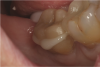 Fig. 7  Restoration insertion. Excess adhesive should be removed with floss prior to final curing.