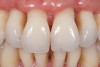 Figure 1  Periodontal surgical procedures on compromised teeth to eliminate deep probing depths usually result in recession interdentally and facially.