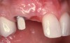 Figure 6a  If teeth Nos. 6 and 7 are missing, one implant should be placed at site No. 6 and site No. 7 should be cantilevered as an ovate pontic. Note that the implant was placed with an abutment at site No. 6.