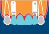 Figure 7  If teeth Nos. 7 through 10 need to be replaced, implants should be inserted at locations Nos. 7 and 10. This facilitates retention of normal sized papilla distal to site Nos. 7 and 10 because the papillary height is determined by the supracrestal fibers from the adjacent natural teeth.