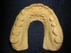 Figure 2  Cast is trimmed with the palatal area removed.