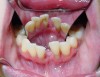 Figure 4  Buccal and lingual clinical views, second appointment.