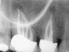 Figure 1c  The previously untreated canal was located, and the treatment was successfully completed.