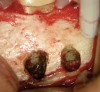 Figure 2b  The patient wanted to keep the new restoration intact. Osteotomy and root-end surgery were performed under a surgical microscope.