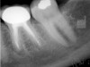 Figure 2d  A 1-year recall radiograph revealed complete bone healing. The patient was free of symptoms.