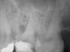Figure 3a  Tooth No. 14 A #15 Hedstrom file had been separated in the distobuccal canal of tooth No. 14.