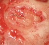 Figure 3c  A microsurgical retrieval became necessary. The fragment was located and removed.