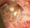 Figure 3d  The distobuccal root was subsequently sealed with MTA. The 1-year recall radiograph shows complete bone healing around the distobuccal root.