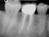 Figure 4f  The 1-year recall radiograph demonstrates the complete resolution of the periradicular radiolucencies.