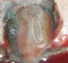 Figure 5b  This procedural error may have delayed the progress of therapy or even made it impossible to thoroughly clean and shape the canal terminus. Root-end surgery was performed to enucleate the periapical pathology and debride previously uncleaned parts of the canals. On the apically resected root surface, an uncleaned portion of 1 canal and an isthmus connecting the 2 main canals became visible under high magnification (Figure 5B), which were prepared to 1 retrocavity using ultrasonic tips (Figure 5C) and filled with MTA (Figure 5D).