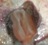 Figure 5c  This procedural error may have delayed the progress of therapy or even made it impossible to thoroughly clean and shape the canal terminus. Root-end surgery was performed to enucleate the periapical pathology and debride previously uncleaned parts of the canals. On the apically resected root surface, an uncleaned portion of 1 canal and an isthmus connecting the 2 main canals became visible under high magnification (Figure 5B), which were prepared to 1 retrocavity using ultrasonic tips (Figure 5C) and filled with MTA (Figure 5D).