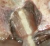 Figure 5d  This procedural error may have delayed the progress of therapy or even made it impossible to thoroughly clean and shape the canal terminus. Root-end surgery was performed to enucleate the periapical pathology and debride previously uncleaned parts of the canals. On the apically resected root surface, an uncleaned portion of 1 canal and an isthmus connecting the 2 main canals became visible under high magnification (Figure 5B), which were prepared to 1 retrocavity using ultrasonic tips (Figure 5C) and filled with MTA (Figure 5D).