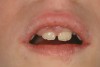 Figure 3  Chronic gingival enlargement of unknown origin in an 8-year old girl. Frontal view.