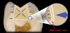 Figure 3  The low modulus of elasticity of RMGIs can counterbalance cusp deformation.