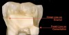 Figure 5  Using an RMGI liner will decrease the chances of redecay in a compromised margin in cementum.