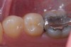 Figure 1a  Mandibular second molar with distal caries. Clinical view.