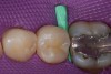 Figure 2  Pre-wedging tooth for rapid separation