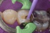 Figure 4  Application of adhesive.