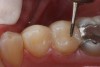 Figure 9  Finishing the occlusal surface with a finishing bur.