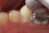 Figure 10  Finishing the occlusal surface with cup-shaped aluminum-oxide silicone abrasive.
