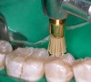 Figure 11  For another case, use of a diamond-impregnated nylon brush.
