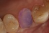 Figure 1  After the tooth was prepared and isolated, the enamel and dentin were etched with 35% phosphoric acid for 30 and 15 seconds, respectively.