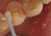 Figure 2  A desensitizer was vigorously applied to the dentin surface with a microbrush applicator for 30 seconds.