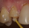 Figure 7  The cementation surface was reactivated with one coat of adhesive, air-thinned, and light-polymerized.