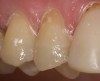 Figure 9  The restoration was then placed with a dual-cure resin cement and light-polymerized.