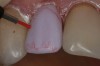 Figure 14  A map of the staining scheme with a red wax margin liner pencil on the facial surface of the crown was drawn.