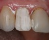 Figure 17  Incisal 2 stain (violet) was applied over the entire surface of the crown to neutralize the chroma (grey) and reduce the value (brightness).