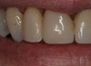 Figure 18  Postoperative view of the single-visit crown.