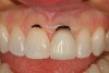Figure 2  A tissue marker is used as a guide for the gingivectomy procedure to balance the gingival heights.