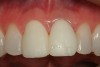 Figure 9  The gingivectomy site is shown with the provisional restorations in place 2 weeks postoperative.