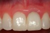 Figure 10  A postoperative view of the completed ceramic restorations.