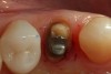 Figure 11  An occlusal view of tooth No. 5 after preparation has been made for a full-coverage restoration.