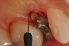 Figure 12  The needle electrosurgery electrode was used to 