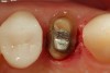 Figure 13  Troughing was completed on the proximal and lingual aspects of the preparation to aid in retraction cord placement prior to making the master impression. The marginal gingiva on the facial aspect was too thin to perform troughing without risking vertical loss of tissue.