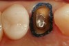 Figure 15  First, a #00, then a #1 retraction cord was 