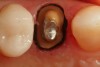 Figure 16  The #1 cord was removed from the sulcus, the #00 remained in place during the making of the master impression. A fully patent sulcus is seen 360° around the preparation.