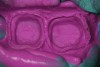 Figure 19  The master impression for tooth Nos. 30 and 31 are shown.