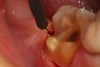 Figure 20  Electrosurgery was performed on the distal of this onlay preparation to gain unimpeded access for the impression material. Note that it is imperative that the biologic width (epithelial and connective tissue attachments) not be disturbed.