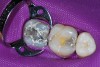 Figure 1  Caries was evident on the mesial of the mandibular first molar.