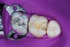 Figure 2  After caries excavation, a deep mesial box resulted.