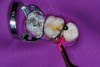 Figure 4  A wedge was placed interproximally to shape the gingival aspect of the proximal box and separate the teeth.