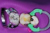 Figure 13  Dual-cure composite base completed to the level of the dentin-enamel junction.