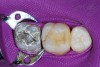 Figure 19  The completed restoration after removal of the matrix, wedge, and retainer demonstrated a tight proximal contact and good contours to the restoration.