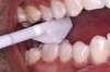 Figure 1  Evaluating a mandibular tooth for a fracture using a bite stick.