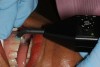 Figure 7B Pulp vitality testing for tooth No. 9 using Gentle-Pulse Pulp Vitality Tester