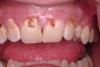 Figure 9B Removal of caries tooth Nos. 8 and 9 reveals nonvital pulp.